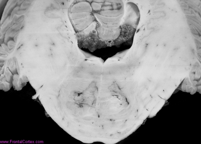 Organizing infarcts (approximately 2 weeks), pontine penetrating artery circulations